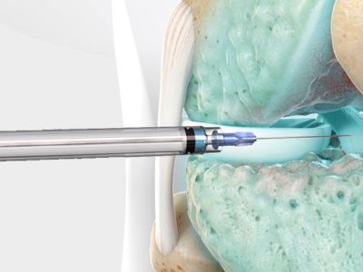 Dublin Certificate in Evidence Based Joint Injection 2026 Dublin Certificate in Evidence Based Joint Injection 2026